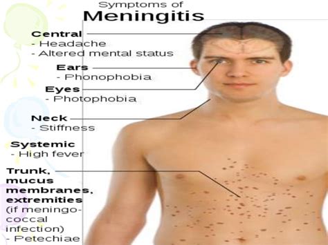 Meningitis Outbreak In Southern California MSM – Health Alert – HIV Thrive