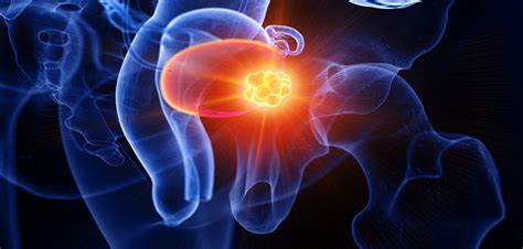 Adding chemotherapy to radiotherapy for bladder cancer shows benefits ...