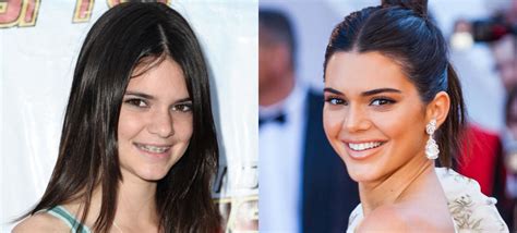 Orthodontics Australia | 6 Celebrities With Braces Before and After ...