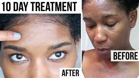 10 DAY TREATMENT for Tiny Forehead + Itchy Chest Acne Bumps - YouTube