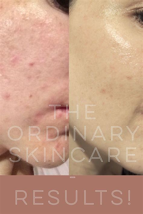 Does The Ordinary Skincare work? Read on to find out. Skip to the end ...