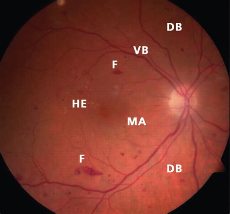 Diabetic retinopathy causes, symptoms, diagnosis, screening & treatment