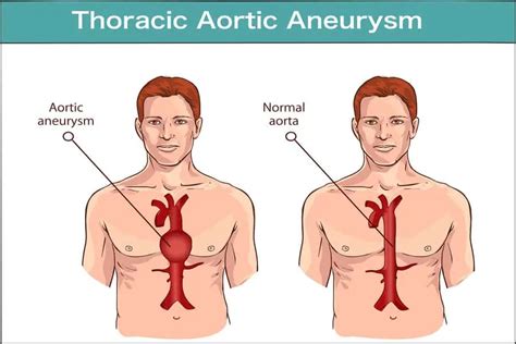 Aortic Aneurysm: A Comprehensive Overview