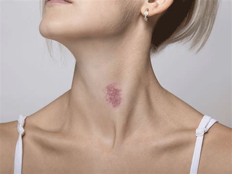 Dermatologists Tell Us Exactly How to Get Rid of a Hickey | SELF