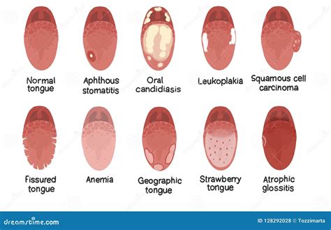 Geographic Tongue Disease In Woman Cartoon Vector | CartoonDealer.com ...