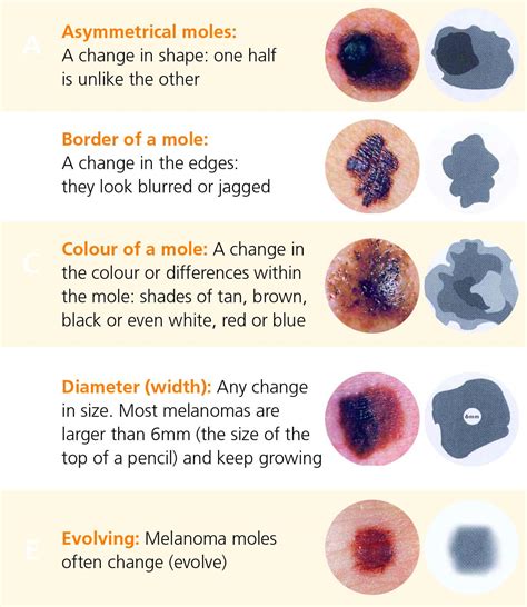 List 98+ Pictures Anatomy Of A Mole On The Skin Updated