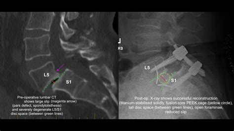 The art of modern spinal surgery: 360-degree (front-back) spinal ...