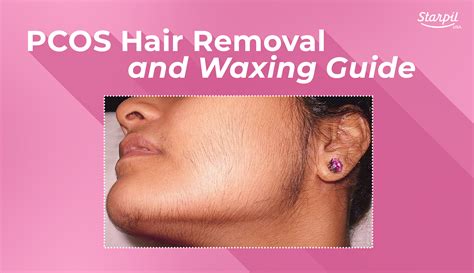 PCOS Hair Removal and Waxing Guide | Starpil Wax