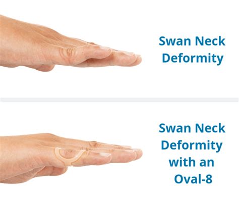 Treating Swan Neck Deformity with Oval-8 Finger Splints