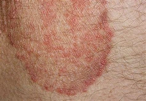 Itchy Skin Rash - Pictures, Causes, Symptoms, Treatment | HubPages