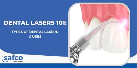 Types of Dental Lasers & Applications | Safco Dental Supply | Safco ...