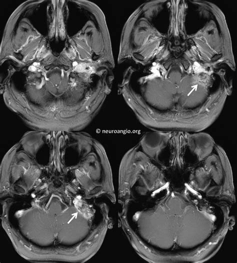 Pulsatile Tinnitus Glomus Jugulare | neuroangio.org