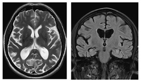 Posterior Cortical Atrophy