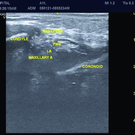 Ultrasound-guided mandibular nerve block. | Download Scientific Diagram