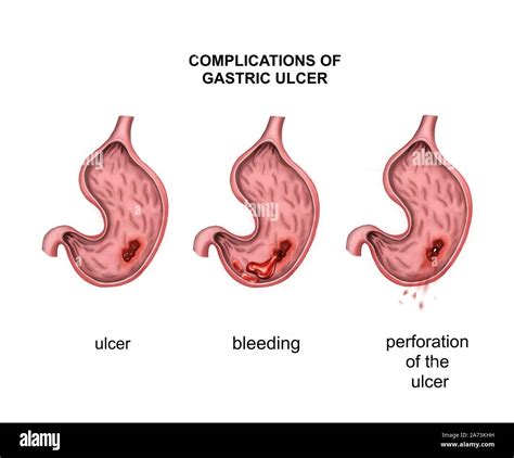 Complications of gastric ulcer. Bleeding and perforation Stock Photo ...