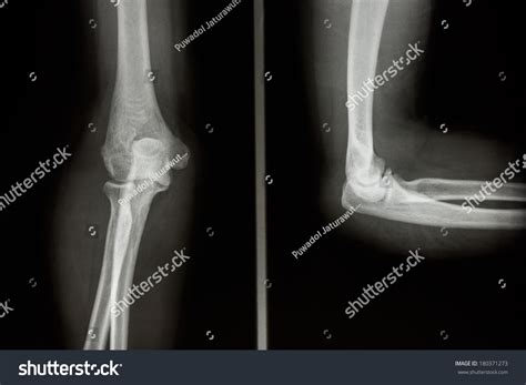 Film Xray Elbow Aplateral Normal Humans Stock Photo 180371273 ...