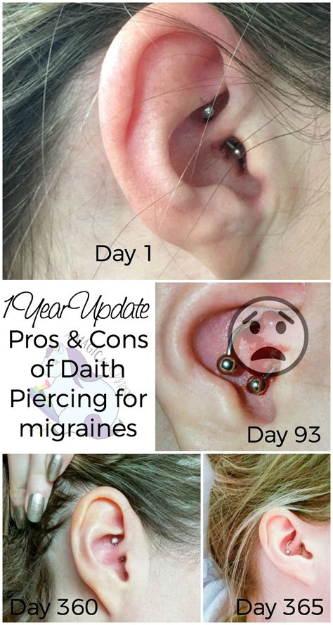 Migraine Piercing - 1 Year Results | Migraña remedios, Remedios ...