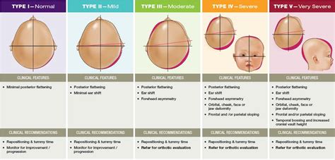 Plagiocephaly Clinic