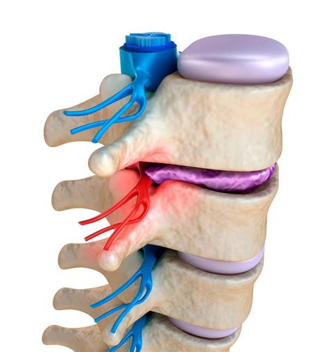 Pinched Nerve Symptoms & Treatments | MN Spine Institute