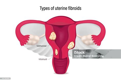 Types Of Uterine Fibroids Submucosal Subserosal And Intramural Fibroids ...