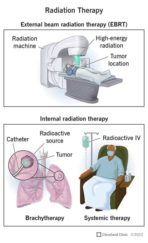 Radiation Therapy for Cancer: How Does It Work?