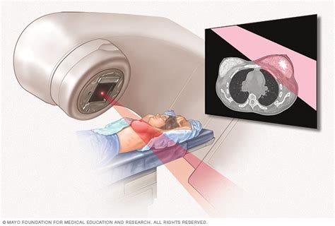 Radiation therapy - Mayo Clinic