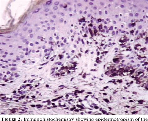 Figure 1 from Hypopigmented mycosis fungoides with 20 years evolution ...