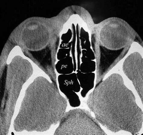 Ethmoid Air Cells