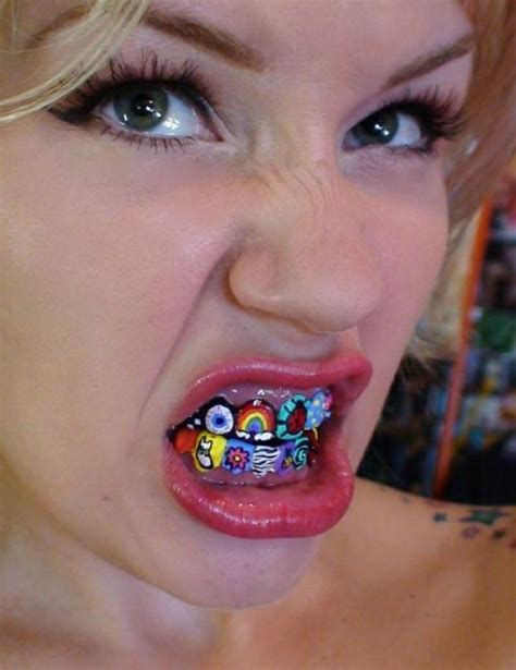 50+ Best Braces Colors For Girls Gif