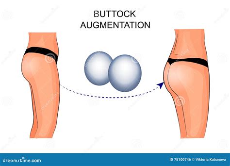 Buttock Augmentation Typography Word Cloud Create With The Text Only ...