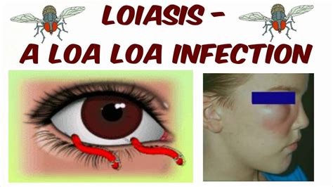 Loa Loa Eye Worm