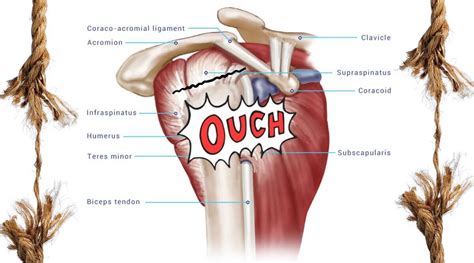 Rotator Cuff Injury - What is it? Diagnosis & treatment for Rotator ...