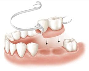 Removable Dental Bridges