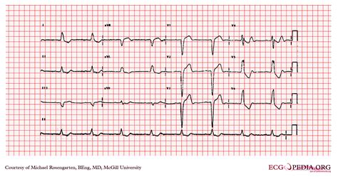 Left bundle branch block EKG examples - wikidoc