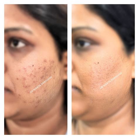 Hyperpigmentation Treatment in Mumbai - Dark Patches Removal