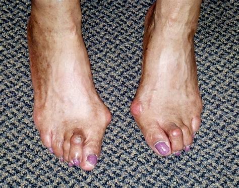 Foot Deformities - Align Your Anklebones