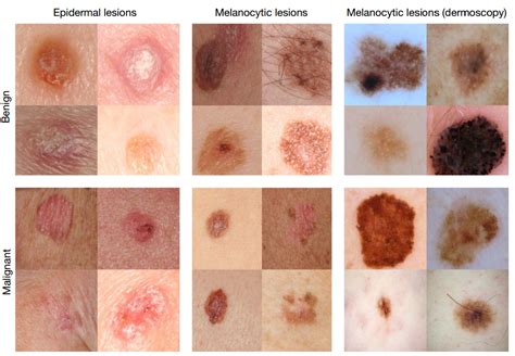 Deep learning algorithm diagnoses skin cancer as well as seasoned ...