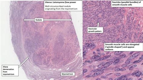 Uterus – Leiomyoma – NUS Pathweb :: NUS Pathweb