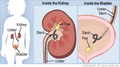 Ureteral Stent | Rady Children's Hospital