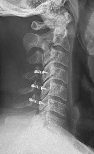 Cervical Laminoplasty vs Laminectomy: What's the Difference?