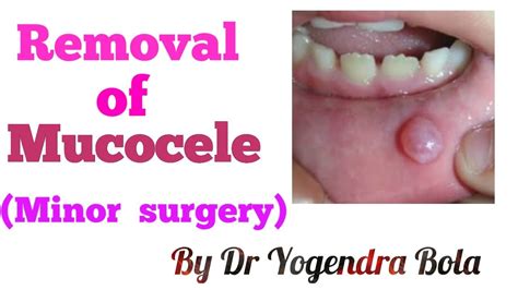 Mucous Retention Cyst Lip Nhs | Sitelip.org