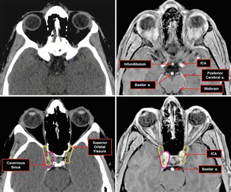 Nerves | Radiology Key