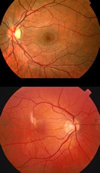 Fundus photography is used to photograph inside the eye