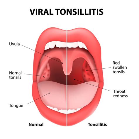 How to get rid of tonsil stones - The tonsil stones advisor | Internet ...