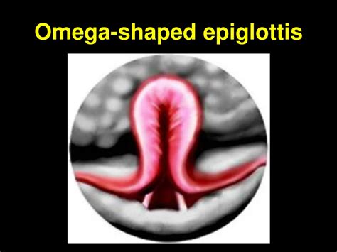 PPT - Congenital Larynx Lesions & Stridor Evaluation PowerPoint ...