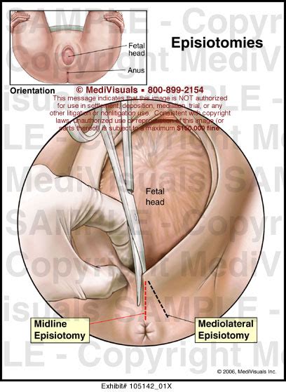 Episiotomies Medical Exhibit Medivisuals