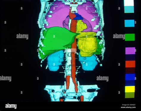 HYDATID CYST, LUNG Stock Photo - Alamy