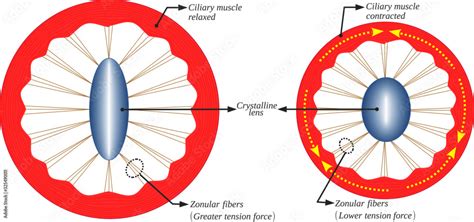 Vecteur Stock The accommodation of the crystalline lens is due to the ...