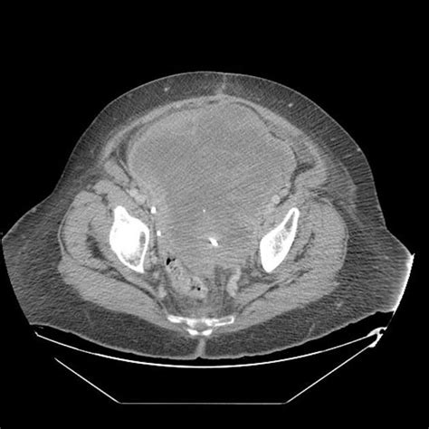 WK 4 L 1 CT Uterine leiomyosarcoma Histology can be similar to ...