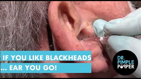 Dr Pimple Popper Blackheads On Ears 2021